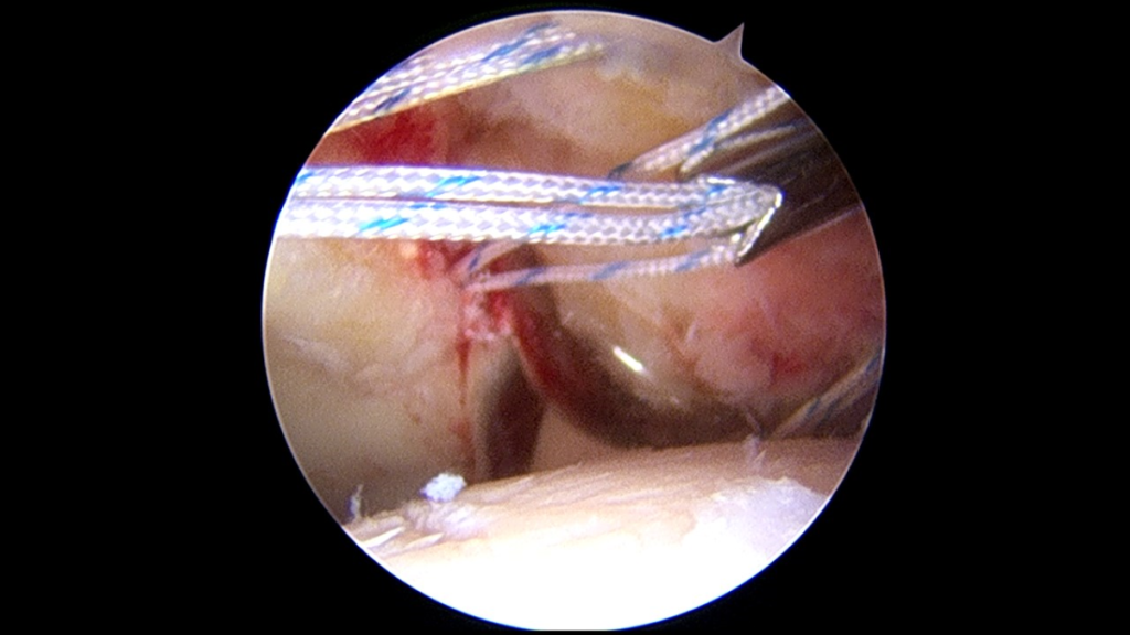 Intraoperatorio artroscopia de cadera para choque femoroacetabular