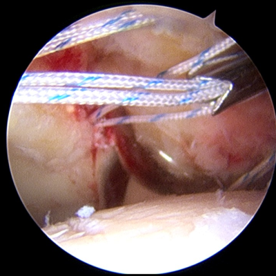 Intraoperatorio artroscopia de cadera para choque femoroacetabular