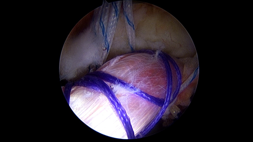 Intraoperatorio artroscopia para choque femoroacetabular