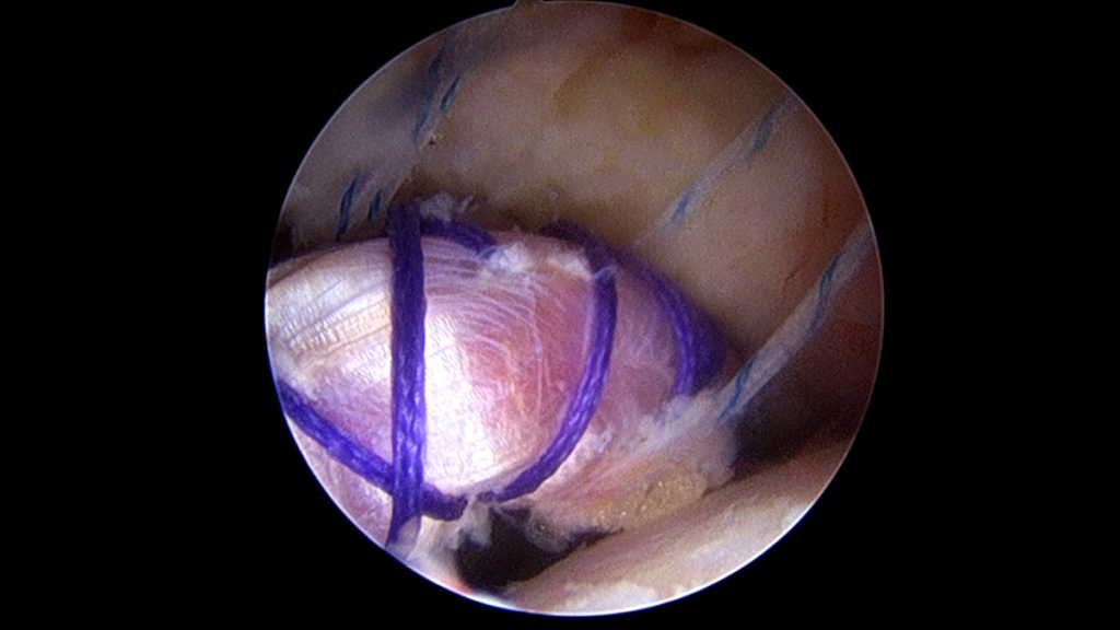 Intraoperatorio artroscopia de cadera para choque femoroacetabular